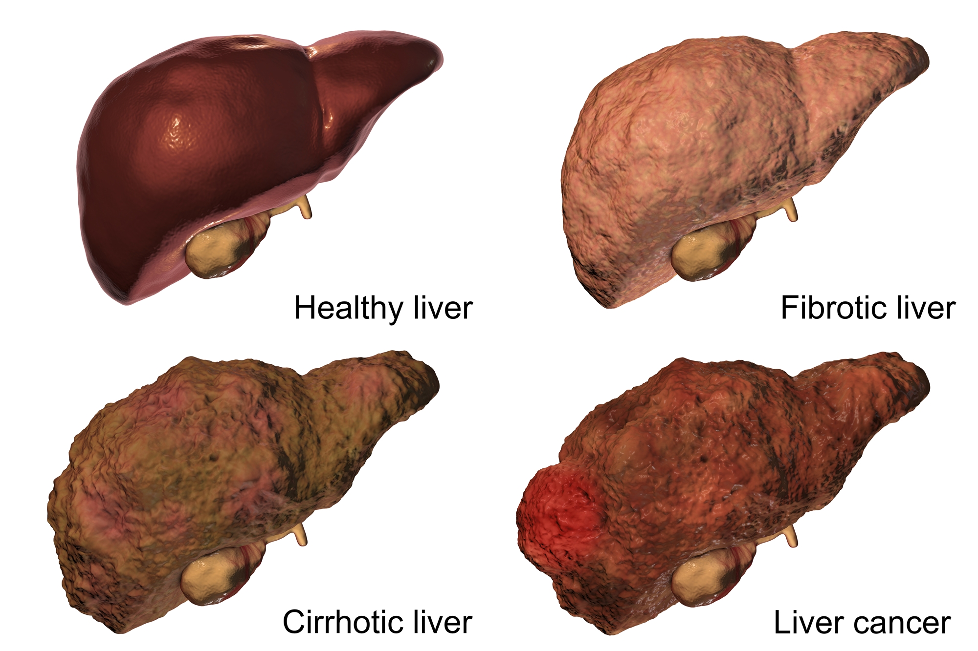 liver cancer